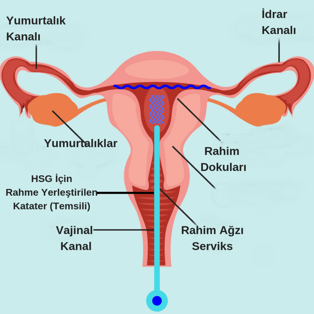 HSG Nasıl Yapılır?